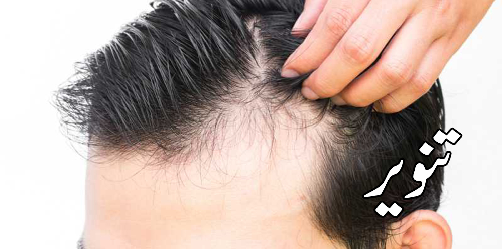 كيفية علاج تساقط الشعر