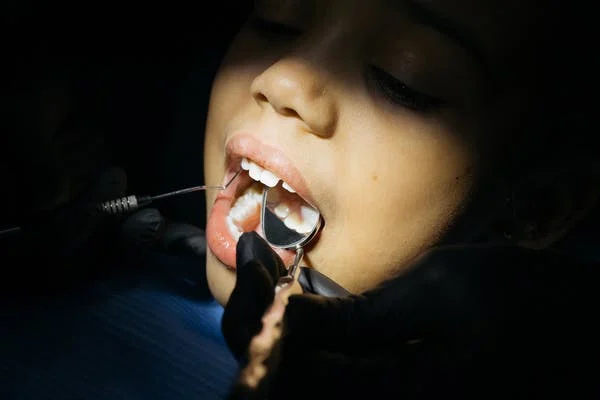 تآكل الأسنان اللبنية عند الأطفال